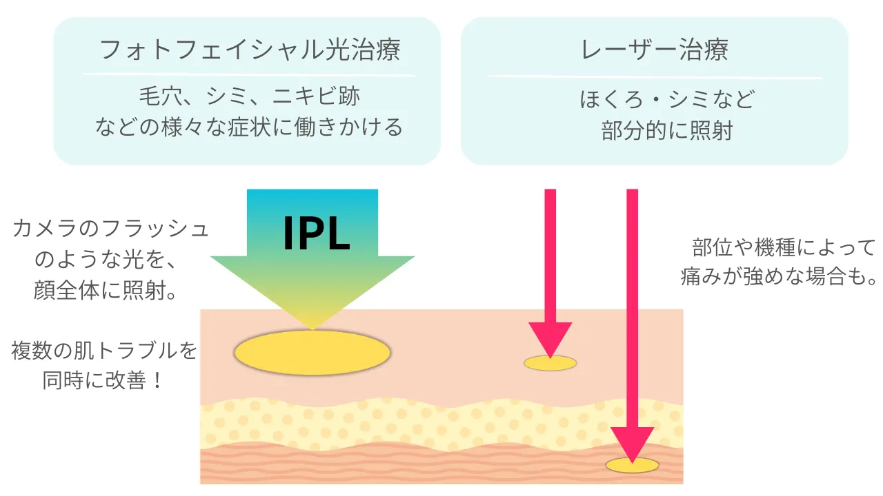 フォトフェイシャルの特徴の説明