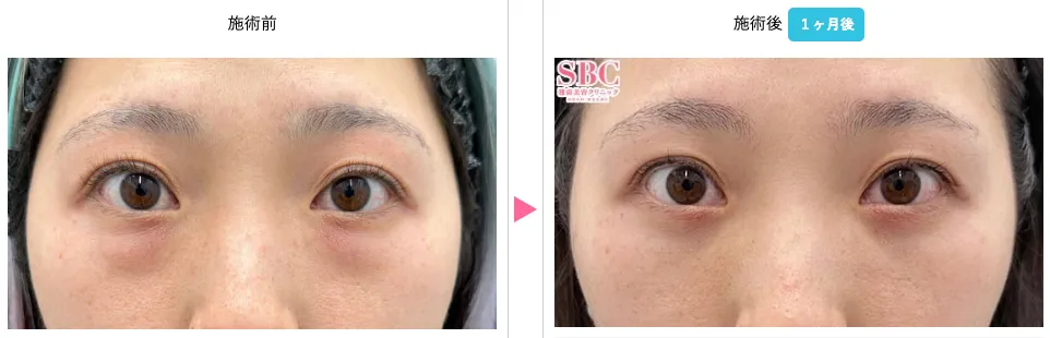 湘南の裏ハムラ症例画像