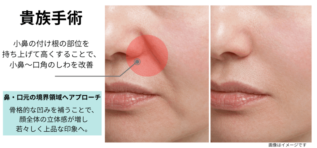 貴族手術の説明