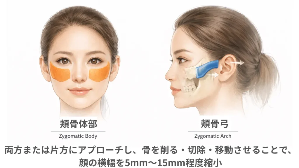 頬骨削りの説明