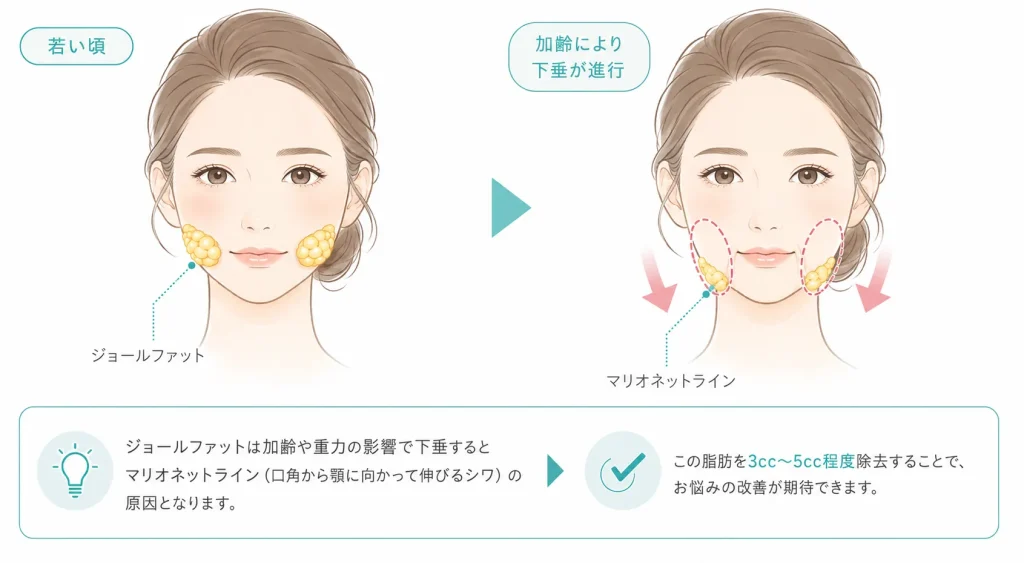 ジョールファット除去説明イラスト